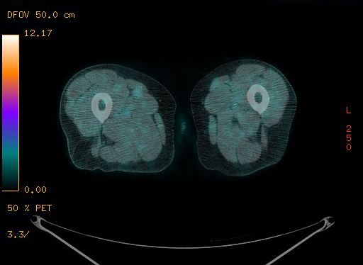 File:Appendiceal adenocarcinoma complicated by retroperitoneal abscess (Radiopaedia 58007-65041 Axial PET-CT 223).jpg