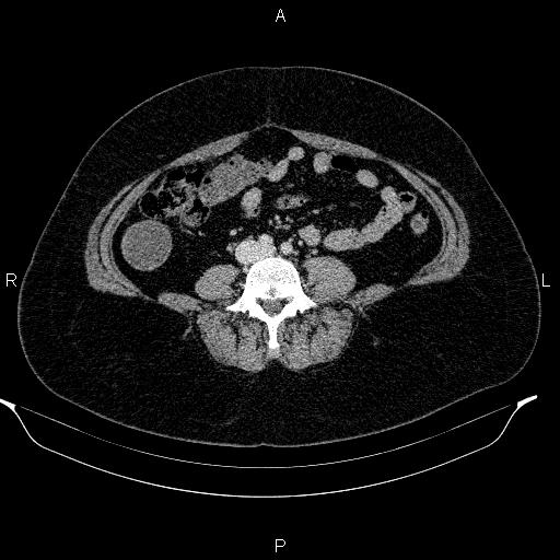 Appendiceal mucocele (Radiopaedia 83280-97688 Axial With contrast 65).jpg