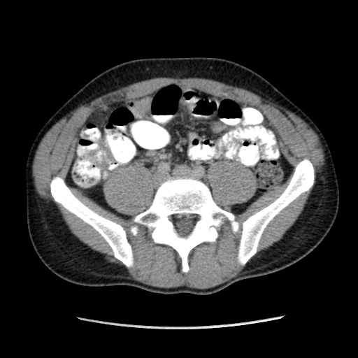 File:Appendicitis complicated by post-operative collection (Radiopaedia 35595-37113 A 49).jpg