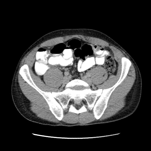 File:Appendicitis complicated by post-operative collection (Radiopaedia 35595-37113 A 54).jpg