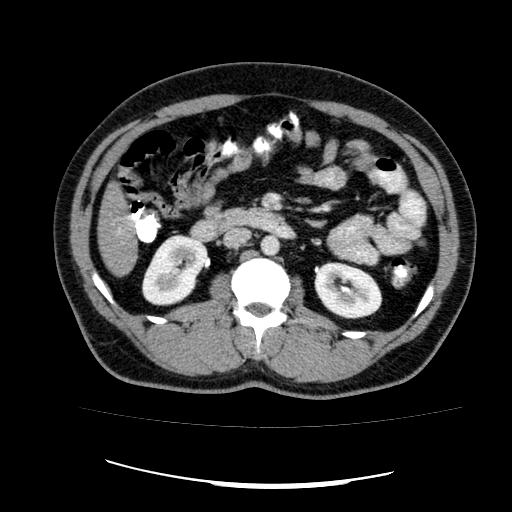 Appendicitis with diverticulosis (Radiopaedia 47693-52383 Axial C+ 60).jpg