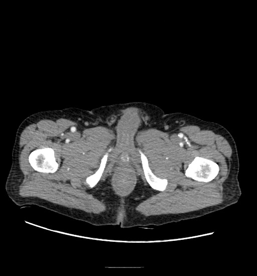 File:Appendicitis with localized perforation and abscess formation (Radiopaedia 49035-54130 A 93).jpg