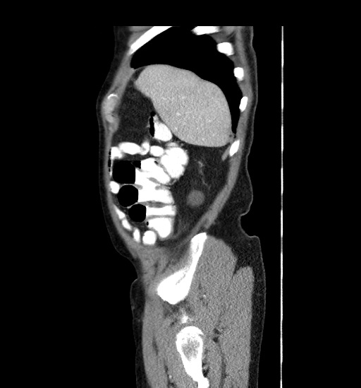 File:Appendicitis with localized perforation and abscess formation (Radiopaedia 49035-54130 C 10).jpg