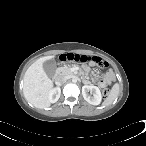 File:Appendicitis with minimal stranding but appendicolith (Radiopaedia 29035-29397 A 28).jpg