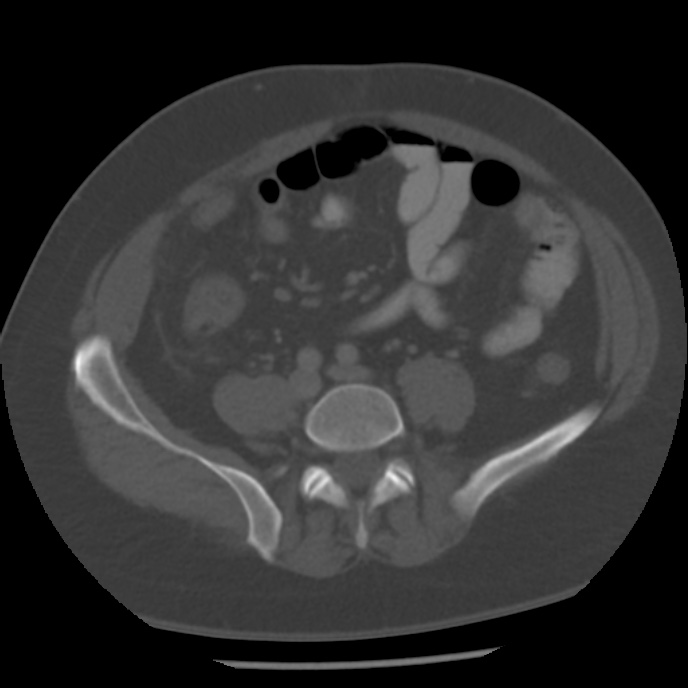 Appendicitis with perforation (Radiopaedia 35790-37342 Axial bone window 34).jpg