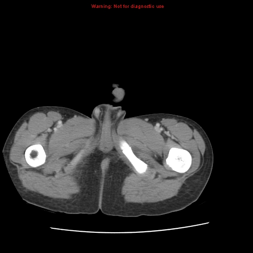 File:Appendicitis with phlegmon (Radiopaedia 9358-10046 A 77).jpg