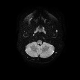 Arachnoid cyst - middle cranial fossa (Radiopaedia 67671-77088 Axial DWI 5).jpg