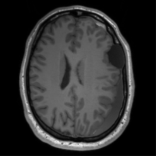File:Arachnoid cyst with subdural hematoma (Radiopaedia 85892-101743 Axial T1 56).png