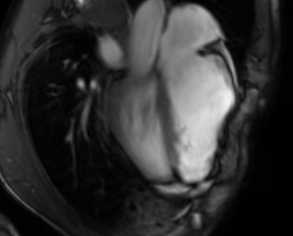 File:Arrhythmogenic right ventricular cardiomyopathy (Radiopaedia 69564-79464 4ch cine 89).jpg