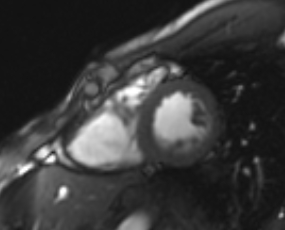File:Arrhythmogenic right ventricular cardiomyopathy (Radiopaedia 69564-79464 short axis cine 105).jpg