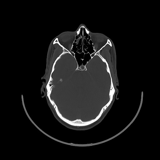 Arrow injury to the brain (Radiopaedia 72101-82607 Axial bone window 61).jpg