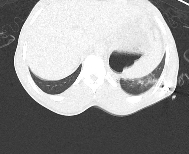 File:Arrow injury to the chest (Radiopaedia 75223-86321 Axial lung window 95).jpg
