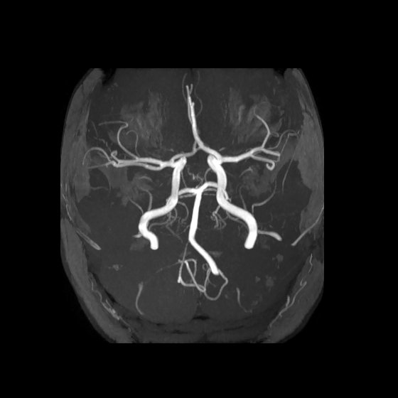 Artery of Percheron infarct (Radiopaedia 40966-43676 F 16).jpg
