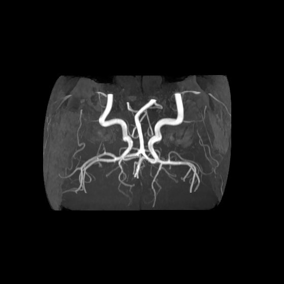 Artery of Percheron infarct (Radiopaedia 40966-43676 F 56).jpg