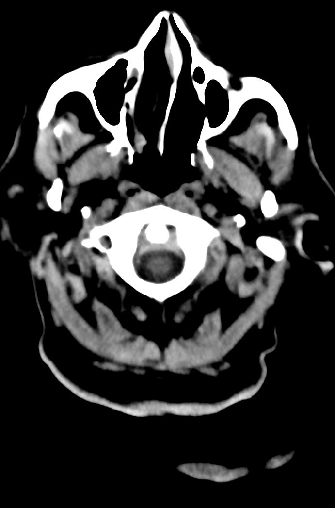 Artery of Percheron infarction (Radiopaedia 80613-94202 Axial non-contrast 14).jpg