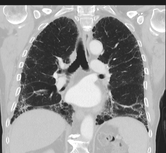 Asbestosis (Radiopaedia 56192-62864 Coronal lung window 30).png