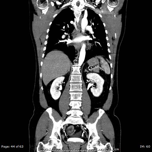 Ascending aortic aneurysm (Radiopaedia 50086-55404 B 44).jpg