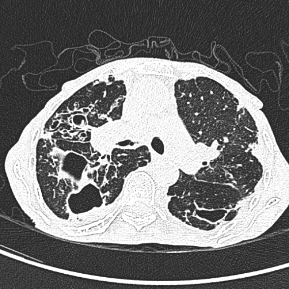 Aspergilloma- with Monod sign (Radiopaedia 44737-48532 Axial lung window 107).jpg