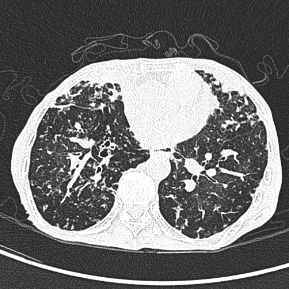 Aspergilloma- with Monod sign (Radiopaedia 44737-48532 Axial lung window 171).jpg