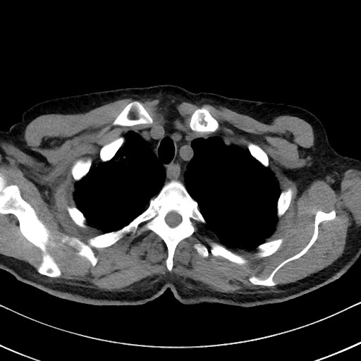 Aspergilloma on background pulmonary fibrosis (Radiopaedia 60942-68757 Axial non-contrast 12).jpg