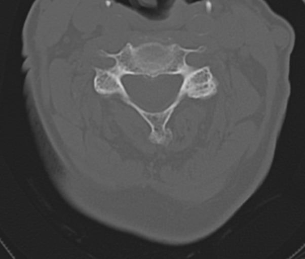 Atlanto-axial subluxation (Radiopaedia 36610-38176 Axial bone window 28).png