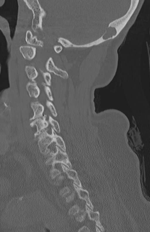 Atlanto-axial subluxation (Radiopaedia 36610-38176 Sagittal bone window 34).png