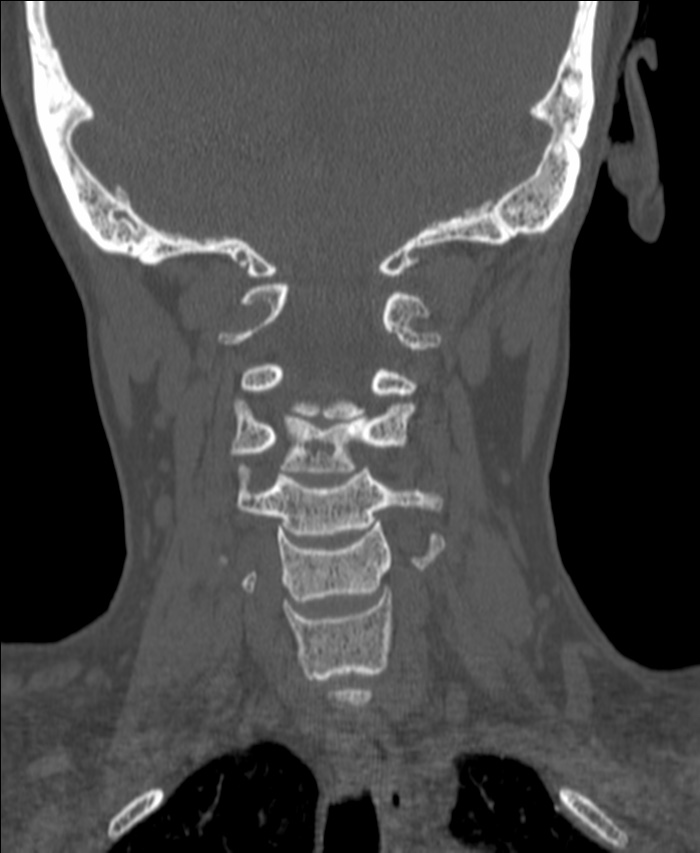 Atlanto-occipital assimilation with basilar invagination (Radiopaedia 70122-80188 Coronal bone window 117).jpg