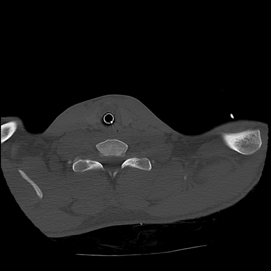 Atlanto-occipital dissociation (Traynelis type 1), C2 teardrop fracture, C6-7 facet joint dislocation (Radiopaedia 87655-104061 Axial bone window 80).jpg