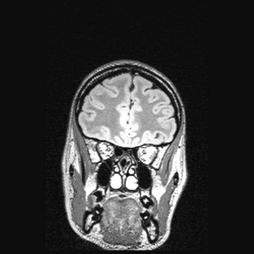 File:Atretic encephalocoele with inferior vermis hypoplasia (Radiopaedia 30443-31108 Coronal FLAIR 139).jpg