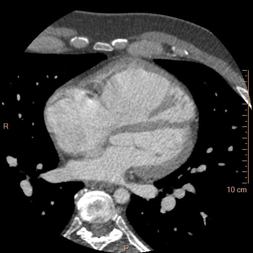 File:Atrial septal defect (upper sinus venosus type) with partial anomalous pulmonary venous return into superior vena cava (Radiopaedia 73228-83961 A 146).jpg
