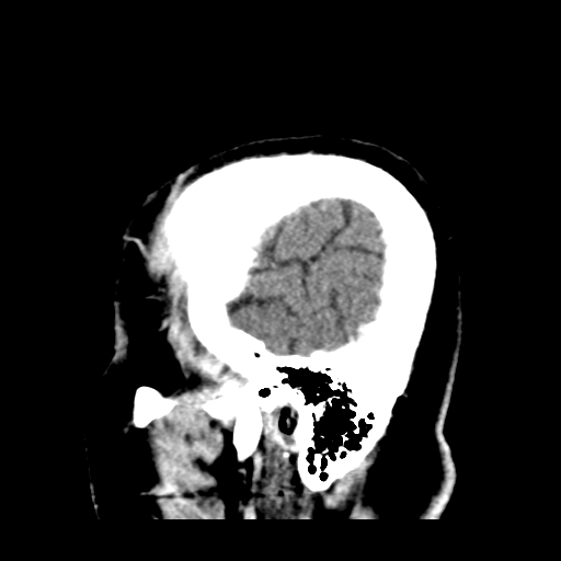 Atypical meningioma (WHO grade II) with brain invasion (Radiopaedia 57767-64728 Sagittal C+ 47).png