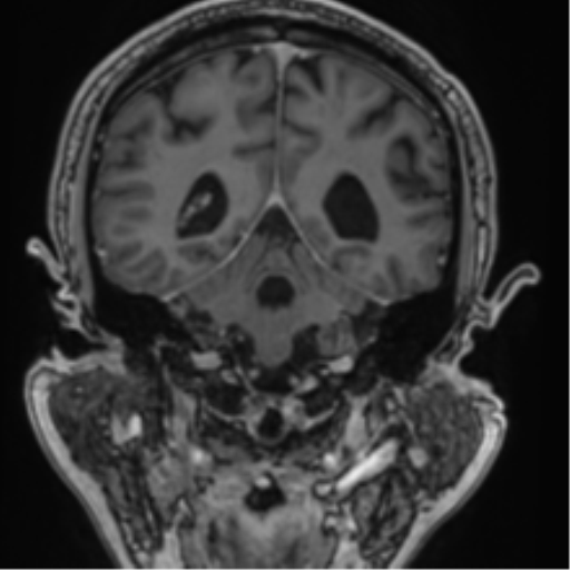 Atypical meningioma (WHO grade II) with brain invasion (Radiopaedia 57767-64729 Coronal T1 C+ 56).png