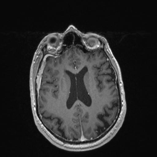Atypical meningioma (grade II) - en plaque (Radiopaedia 29633-30147 Axial T1 C+ 118).jpg