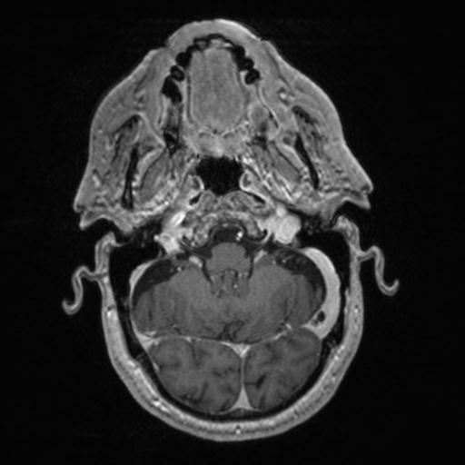 Atypical meningioma (grade II) - en plaque (Radiopaedia 29633-30147 Axial T1 C+ 46).jpg