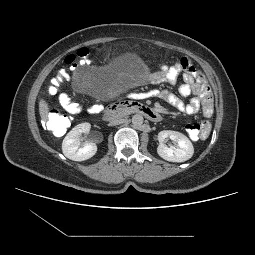 File:Atypical retroperitoneal lymphocoeles with large leiomyoma of uterus (Radiopaedia 32084-33024 A 18).jpg