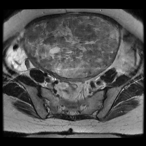 File:Atypical retroperitoneal lymphocoeles with large leiomyoma of uterus (Radiopaedia 32084-33027 Axial T2 15).jpg