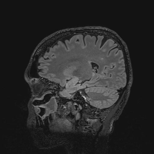 Autoimmune limbic encephalitis (Radiopaedia 30363-31005 Sagittal FLAIR 60).jpg