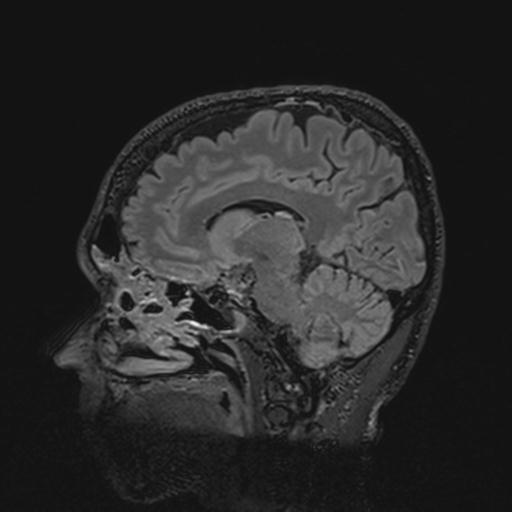 Autoimmune limbic encephalitis (Radiopaedia 30363-31005 Sagittal FLAIR 90).jpg