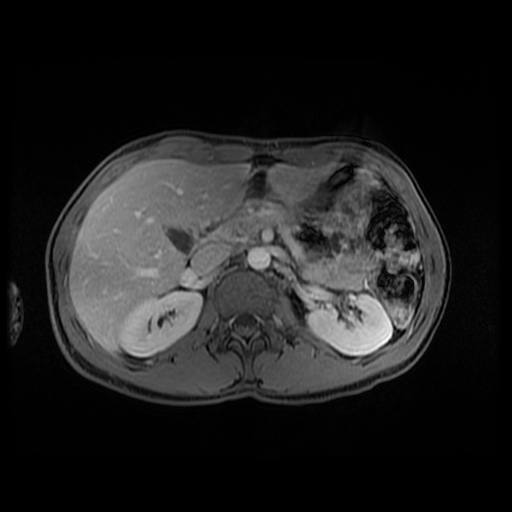 Autoimmune pancreatitis (Radiopaedia 69751-79729 M 61).jpg