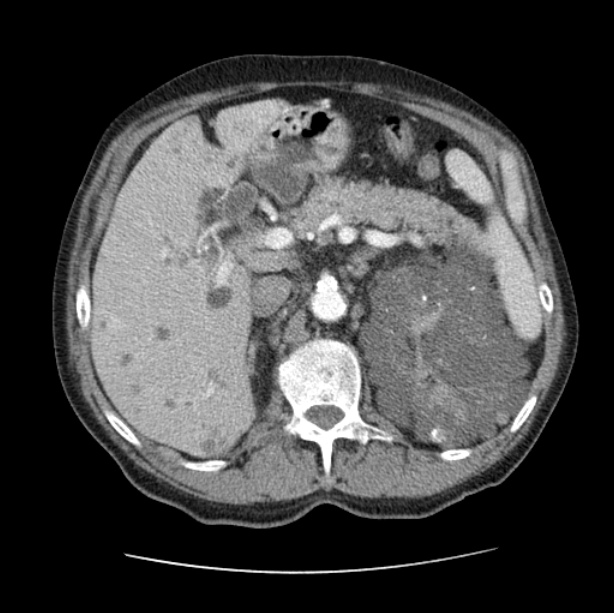 Autosomal dominant polycystic kidney disease (Radiopaedia 27851-28094 B 63).jpg