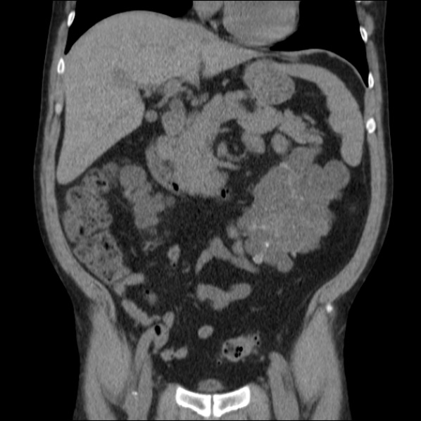 File:Autosomal dominant polycystic kidney disease (Radiopaedia 36539-38101 C 29).jpg