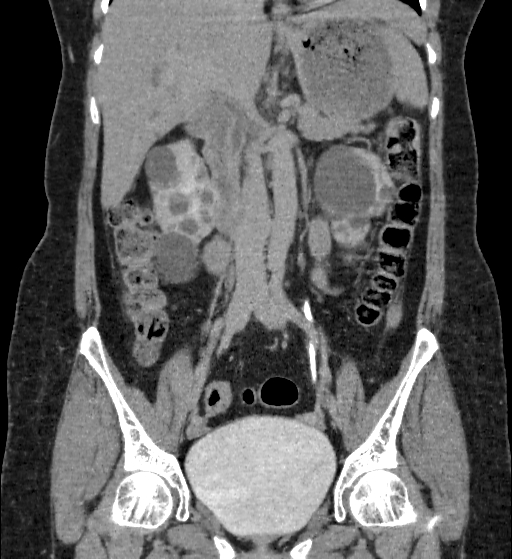 File:Autosomal dominant polycystic kidney disease (Radiopaedia 38189-40194 Coronal C+ delayed 41).jpg