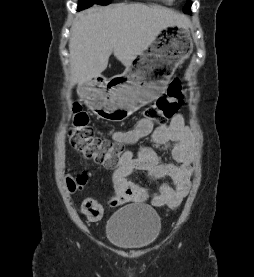File:Autosomal dominant polycystic kidney disease (Radiopaedia 38189-40194 Coronal C+ delayed 9).jpg