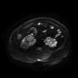 File:Autosomal dominant polycystic kidney disease (Radiopaedia 50259-55611 Axial DWI 67).jpg