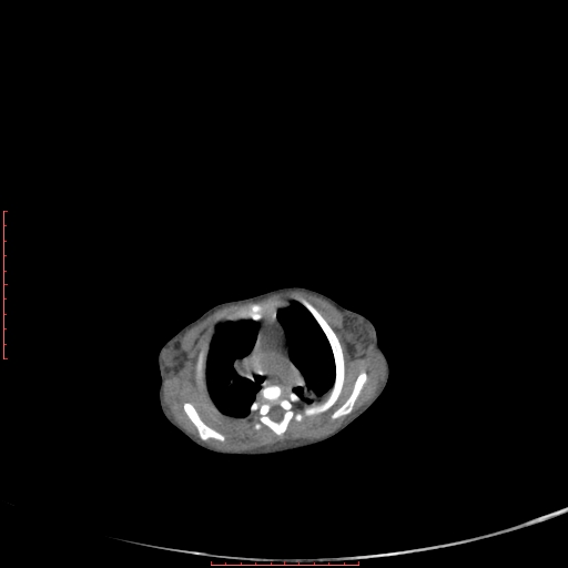 Autosomal recessive polycystic kidney disease associated with Caroli disease (Radiopaedia 61932-69984 Axial non-contrast 29).jpg