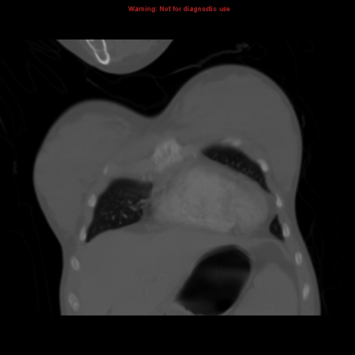 Avascular necrosis in sickle cell disease (Radiopaedia 17448-17152 Coronal bone window 21).jpg