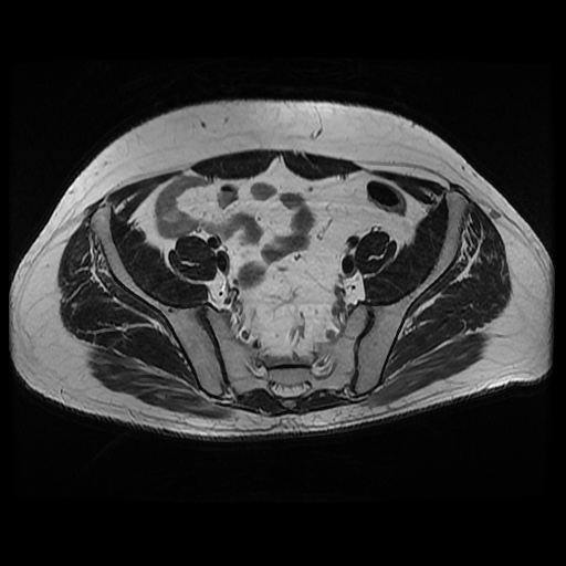File:Avascular necrosis of the hip (Radiopaedia 61503-69465 T2 5).jpg