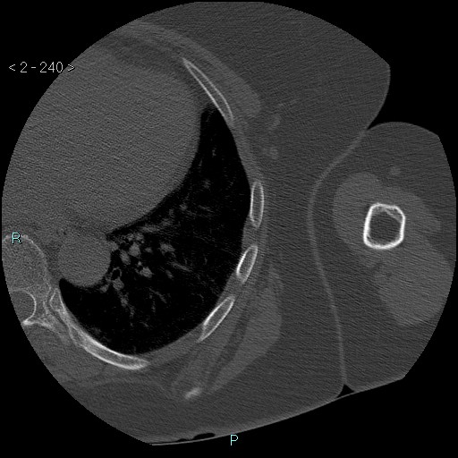 Avascular necrosis of the shoulder - Cruess stage I (Radiopaedia 77674-89887 Axial bone window 60).jpg
