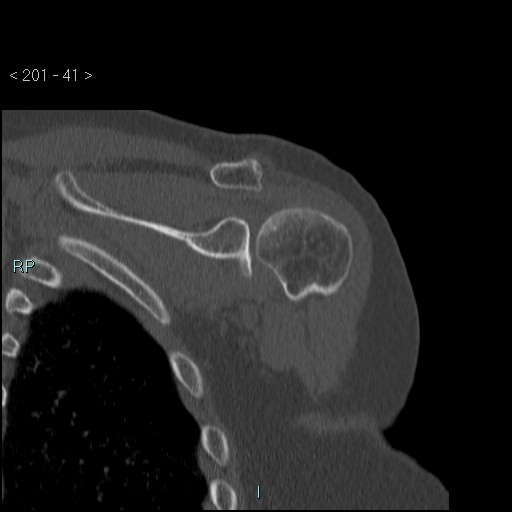 Avascular necrosis of the shoulder - Cruess stage I (Radiopaedia 77674-89887 Coronal bone window 40).jpg