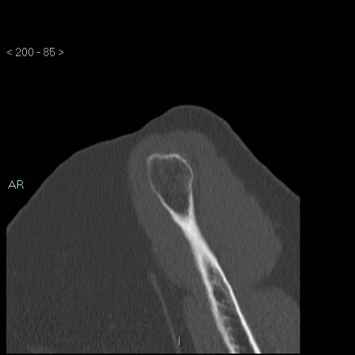 Avascular necrosis of the shoulder - Cruess stage I (Radiopaedia 77674-89887 Sagittal bone window 84).jpg